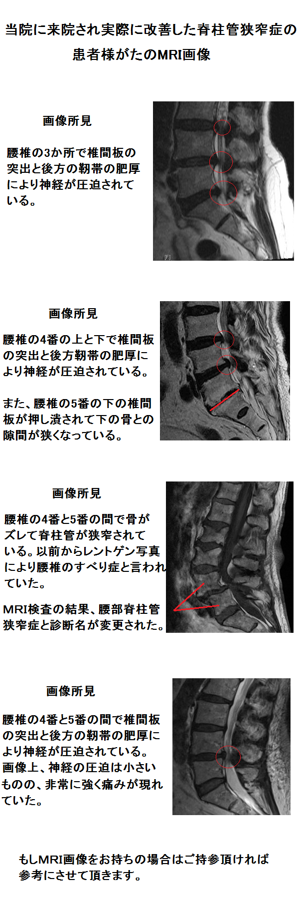 きょうさくMRI.png