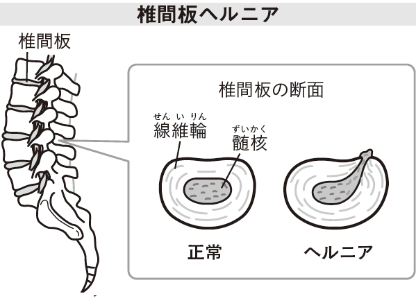 ヘルニア２.png